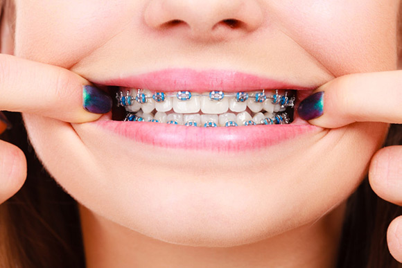 How to Take Care of Your Braces At Home